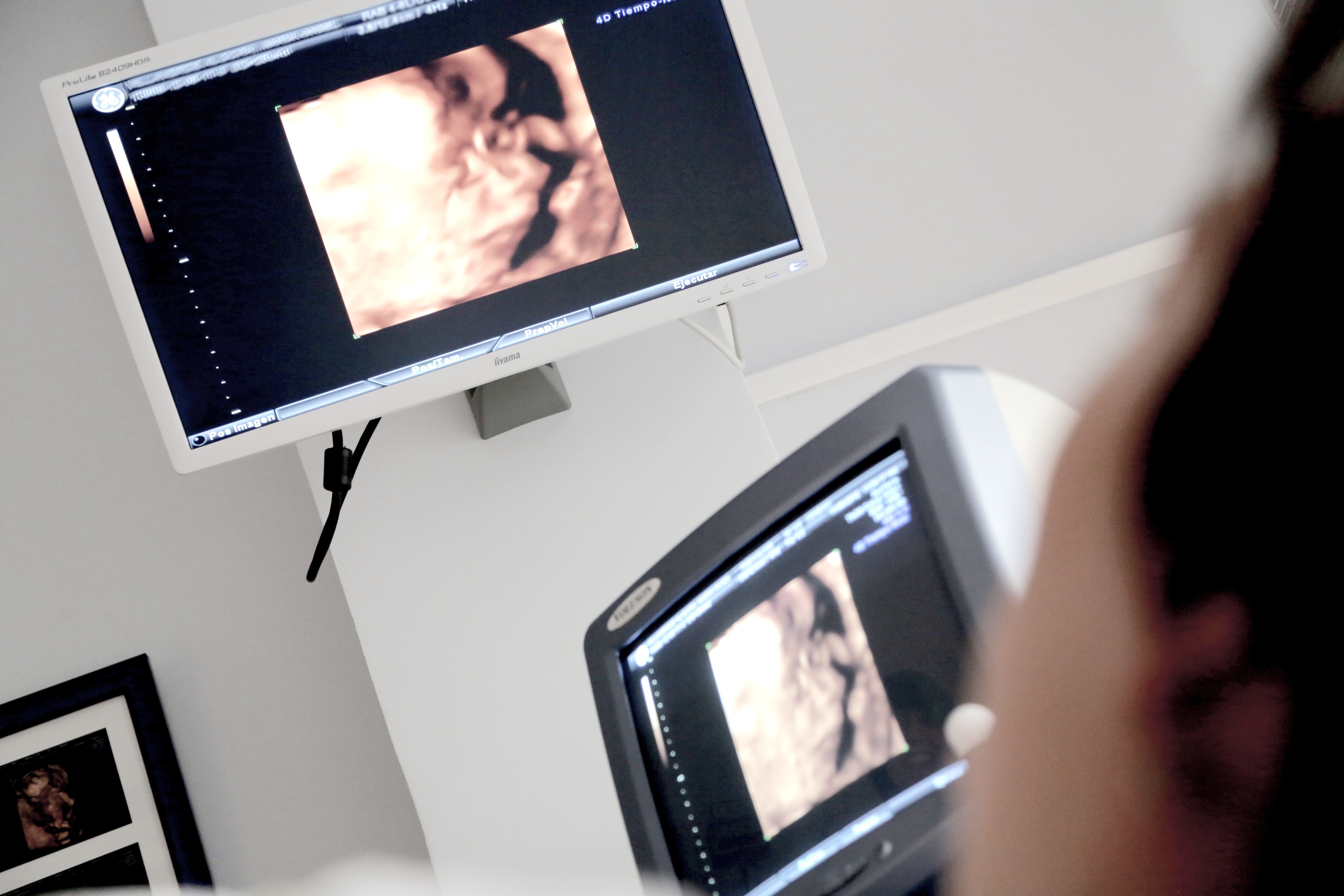 A person is viewing an ultrasound image on a screen in a medical setting. The ultrasound displays a blurred, warm-toned image of a developing fetus. Another screen nearby shows a similar ultrasound image, suggesting an examination taking place.