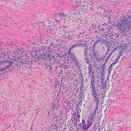 Microscopic view of tissue, showcasing cells and structures in shades of pink and purple. The image highlights various cellular arrangements and layers, providing insight into the tissue's composition and characteristics, typical of histological analysis in medical studies.